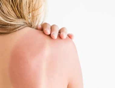 Καήκατε από τον Ήλιο; - Μην βάλετε γιαούρτι!